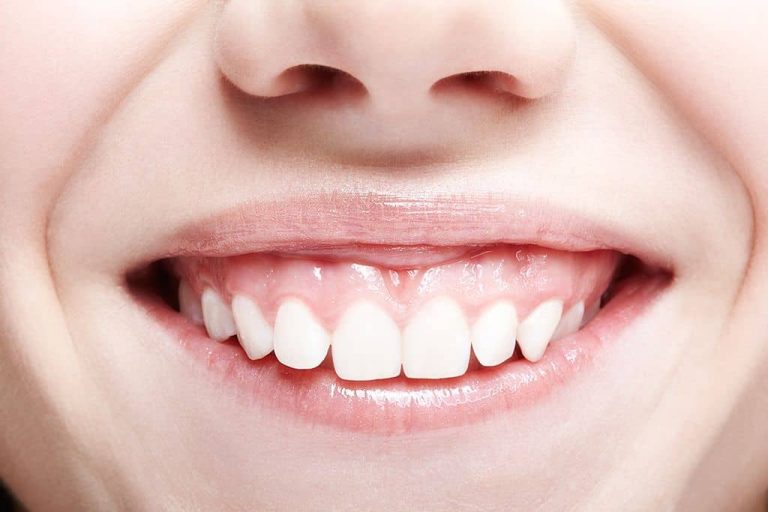 What is gum smile correction?