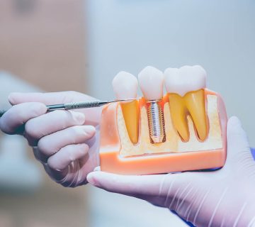 Advanced methods in dental implants