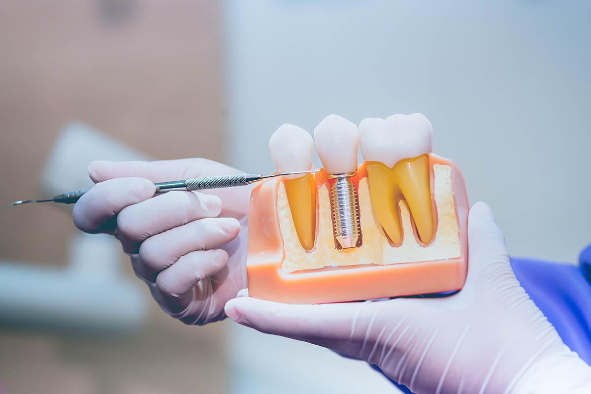 Advanced methods in dental implants