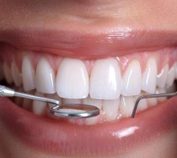 Does composite cause tooth decay?