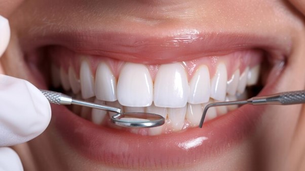 Does composite cause tooth decay?