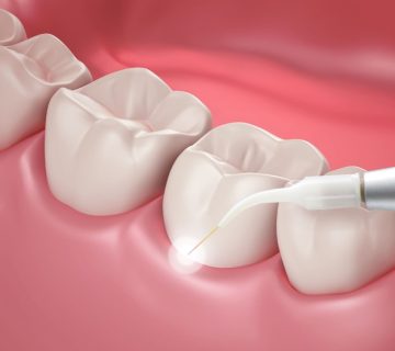 Cosmetic gum surgery