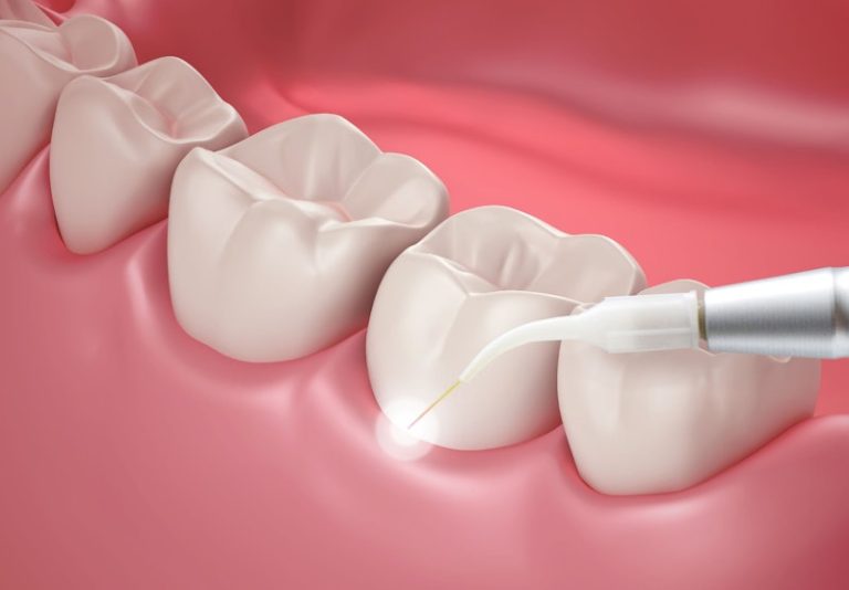Cosmetic gum surgery