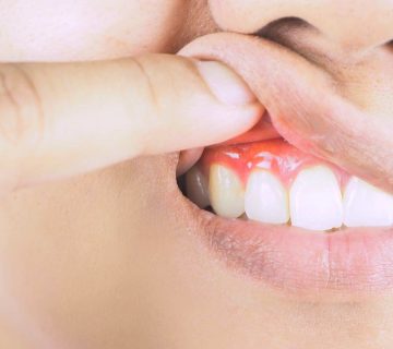 Gum diseases