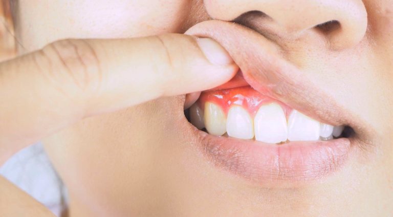 Gum diseases