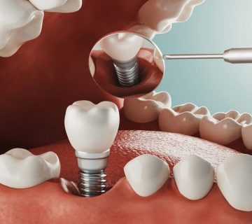 Successful implant placement