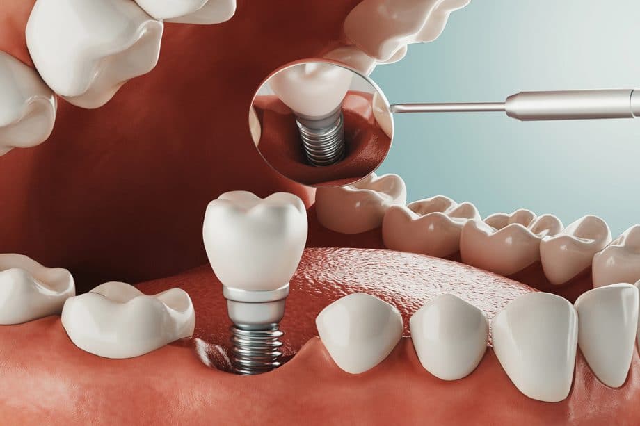 Successful implant placement