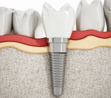 The effect of osteoporosis on dental implants