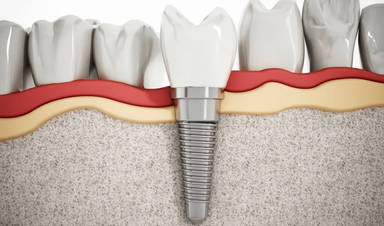 The effect of osteoporosis on dental implants