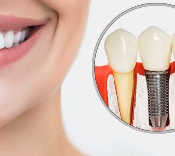 Implants and natural teeth