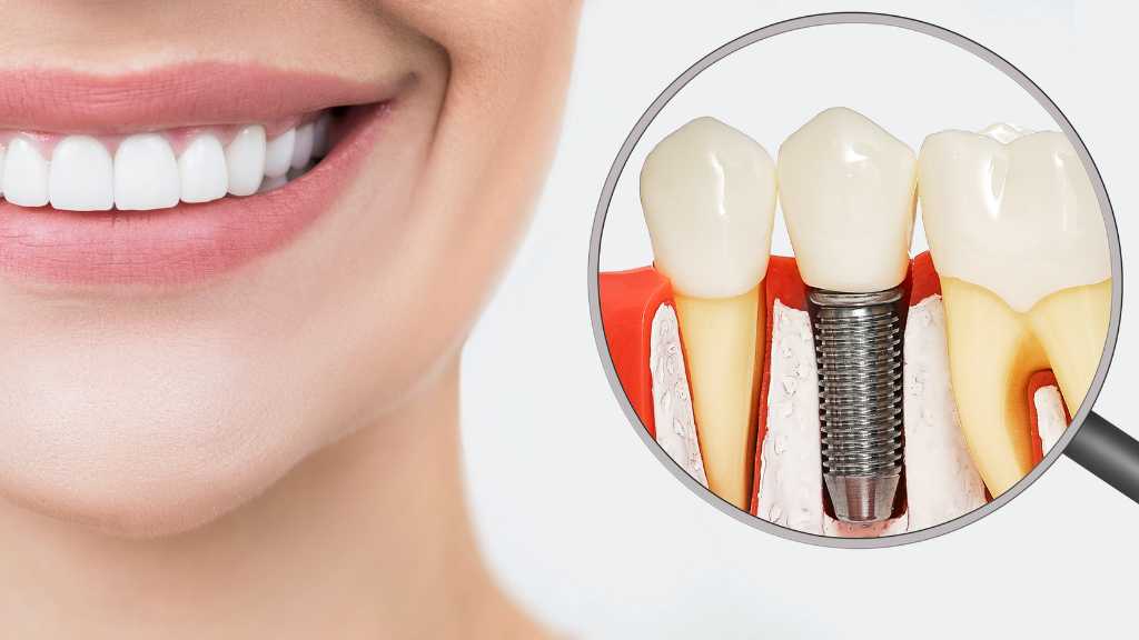 Implants and natural teeth
