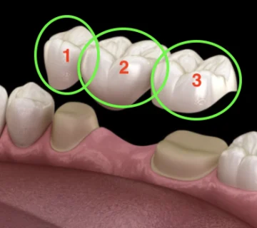 Reasons for replacing a fallen tooth