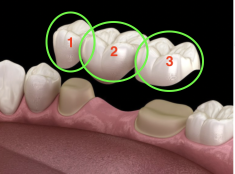 Reasons for replacing a fallen tooth