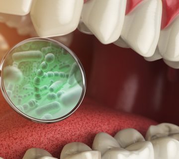 dental plaque