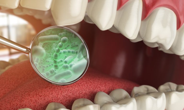 dental plaque