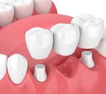 Dental bridge