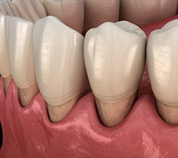 Periodontal diseases