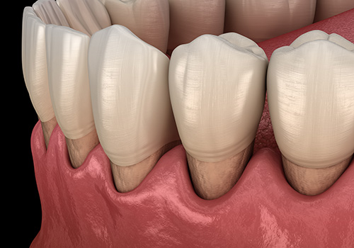 Periodontal diseases
