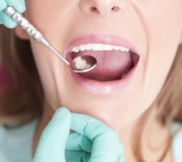 mouth sores