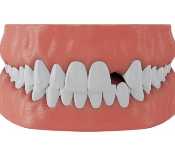 fallen tooth