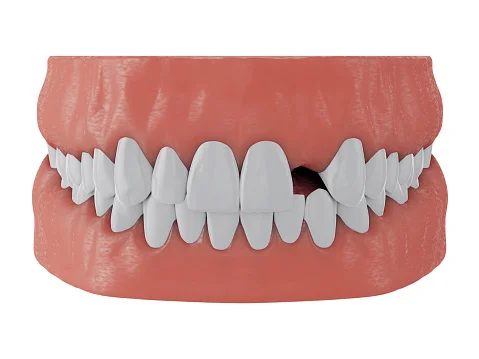 fallen tooth