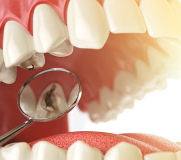 Tooth decay