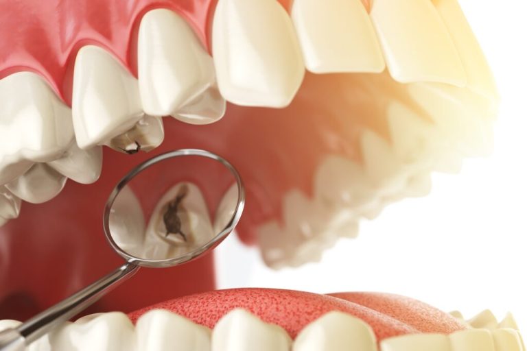 Tooth decay