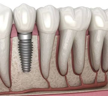 Dental implant failure