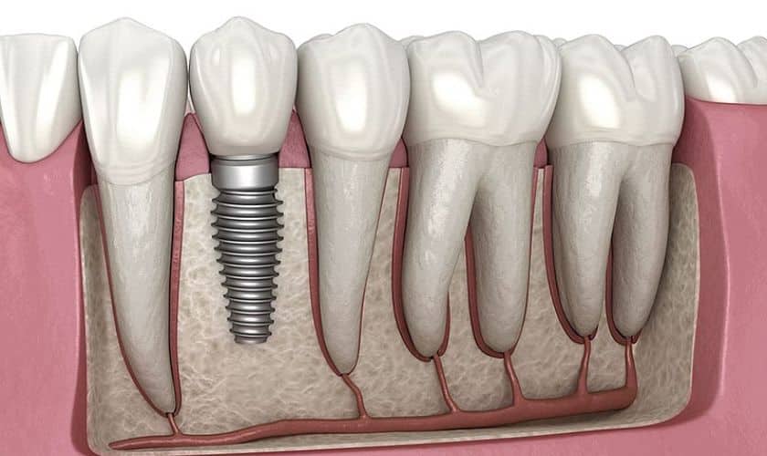 Dental implant failure