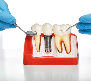 New coating of dental implants