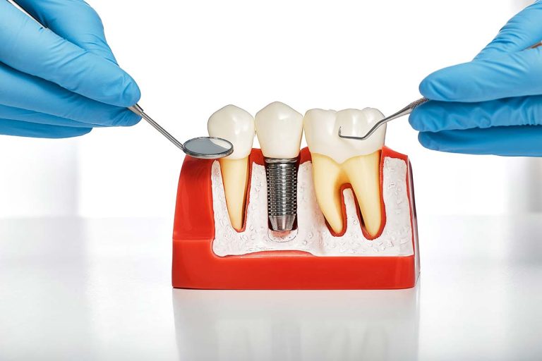 New coating of dental implants