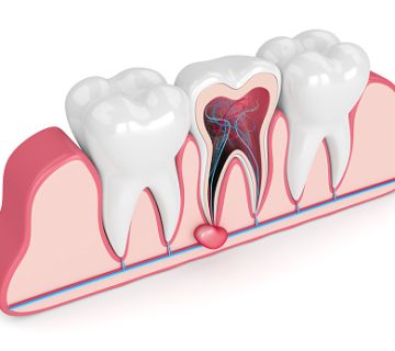 Tooth cyst