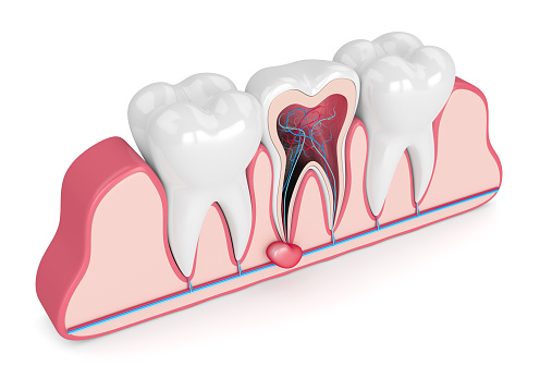 Tooth cyst