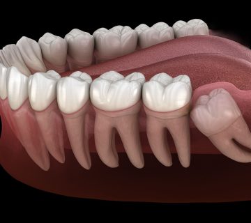 The best time to extract wisdom teeth