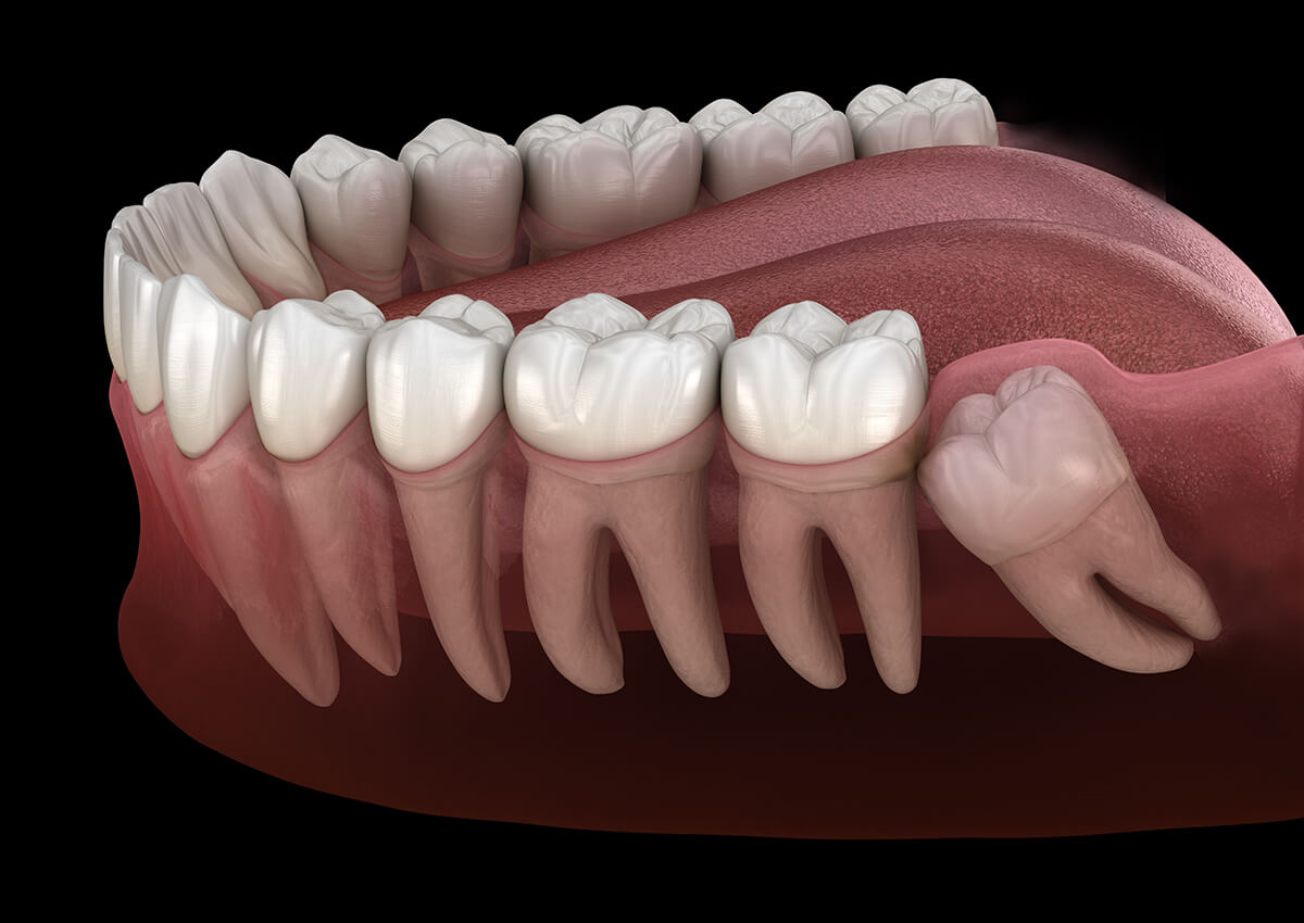 The best time to extract wisdom teeth