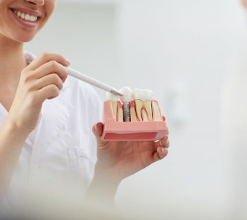 Five impressive structural differences between implants and natural teeth