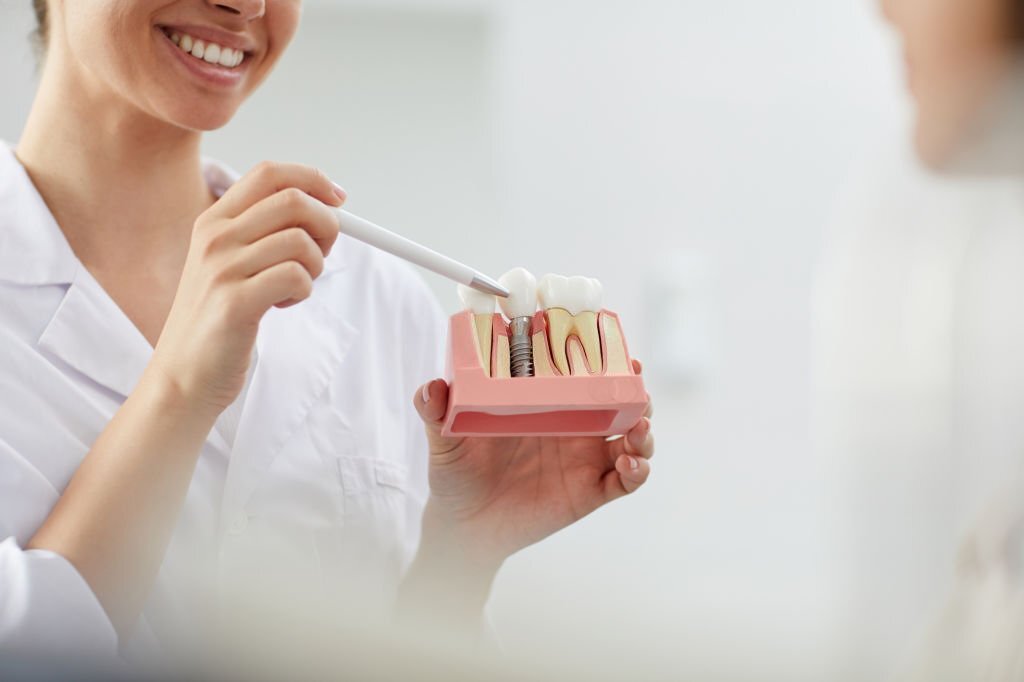 Five impressive structural differences between implants and natural teeth
