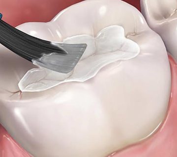 fissure sealant