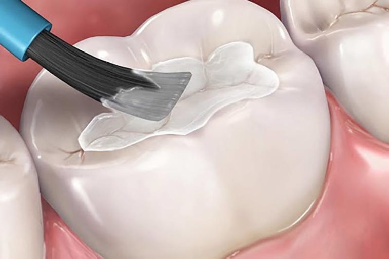 fissure sealant