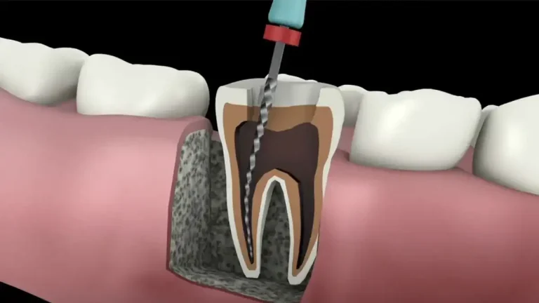 Root canal