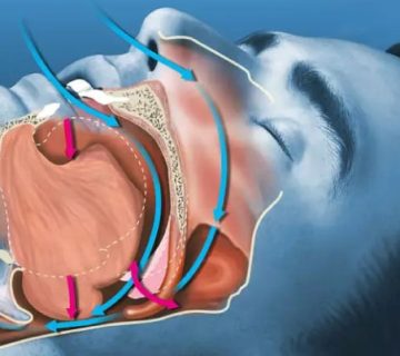 Obstructive apnea and implants