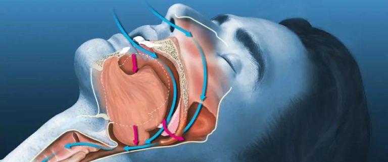 Obstructive apnea and implants