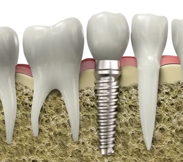 Dental implant treatment in patients with osteoporosis