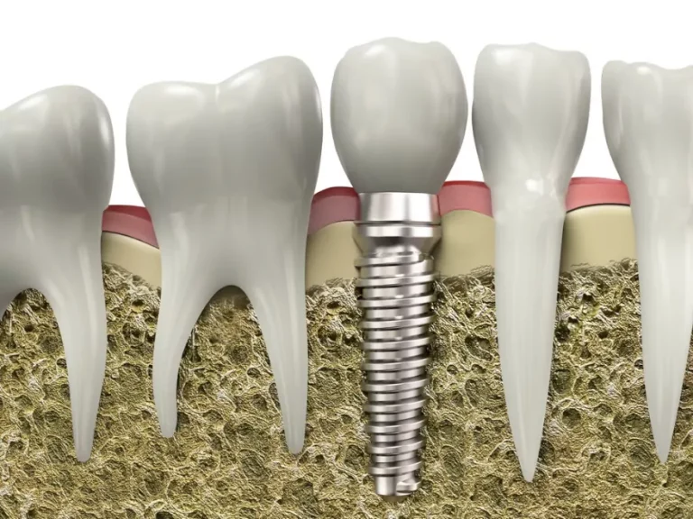 Dental implant treatment in patients with osteoporosis
