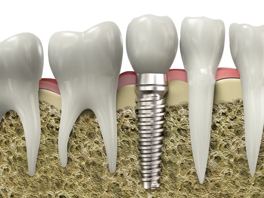 Dental implant treatment in patients with osteoporosis