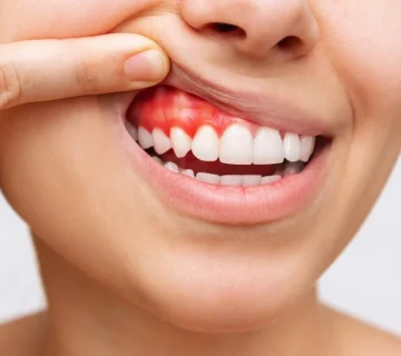 Types of gum disease and hidden symptoms of gum disease