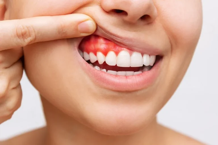 Types of gum disease and hidden symptoms of gum disease
