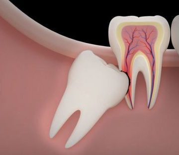 Hidden wisdom teeth