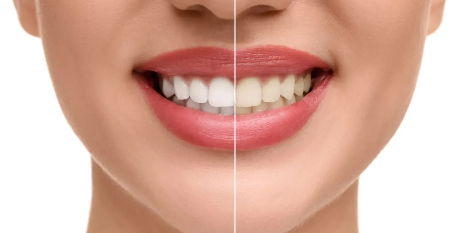 Care after teeth bleaching at home