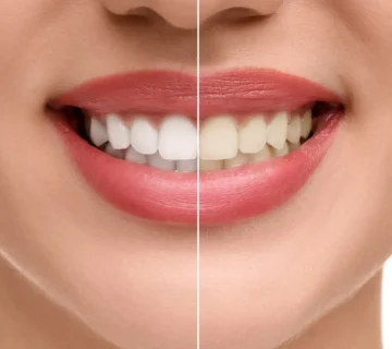 Care after teeth bleaching at home